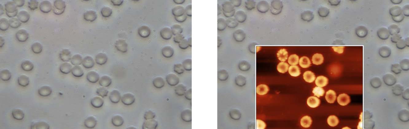 Correlative Optical imaging/AFM morphology on favism red blood cells